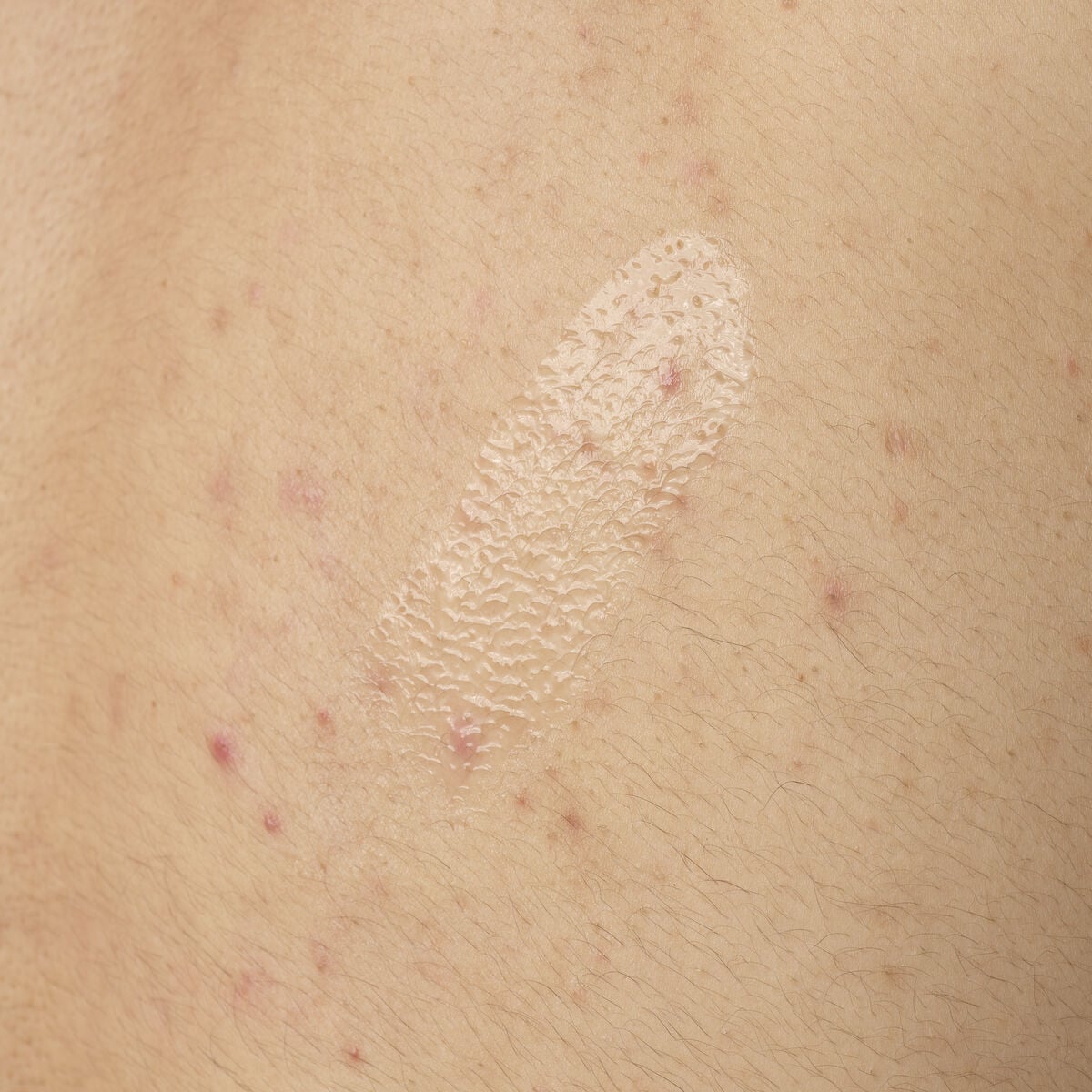 salicylic-acid-0-5-body-serum-g2 ORD-salicylic-acid-05-body-240ml-application.jpg