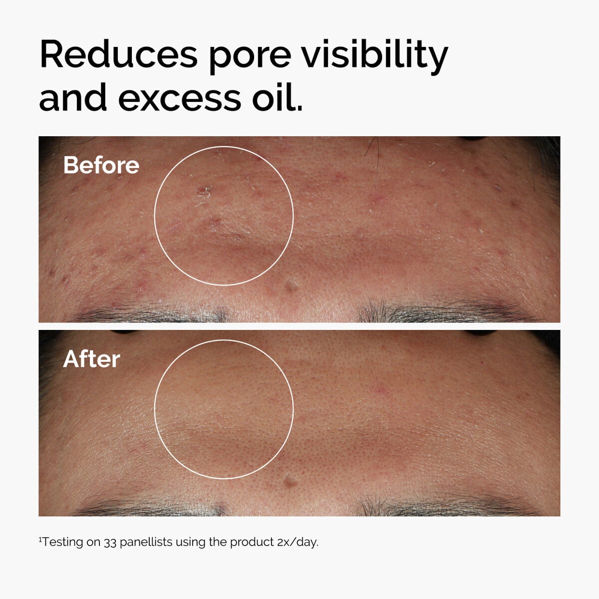 niacinamide-10-zinc-1-e3 ord-niacinamide-zinc-blemish-serum-before-after-pores.jpg
