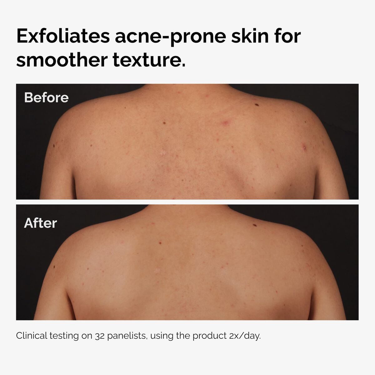 salicylic-acid-0-5-body-serum-g2 ord-salicylic-acid-body-serum-before-after-graphic-NA.jpg