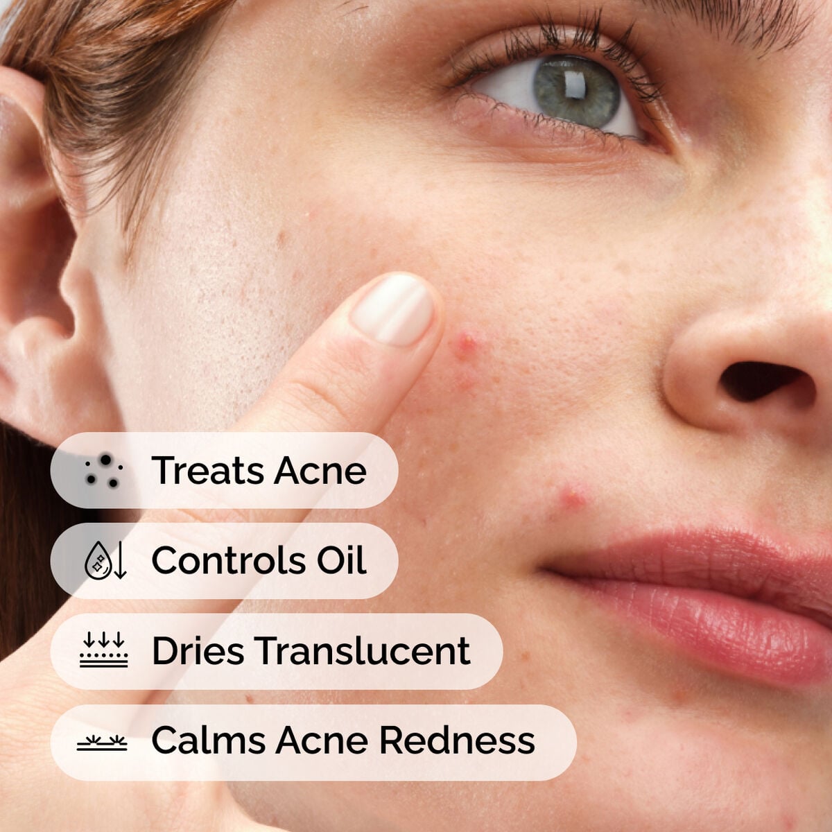 sulfur-10-powder-to-cream-concentrate-m8 ord-sulfur-10pct-powder-to-cream-concentrate-model-application-with-benefits-acne.jpg