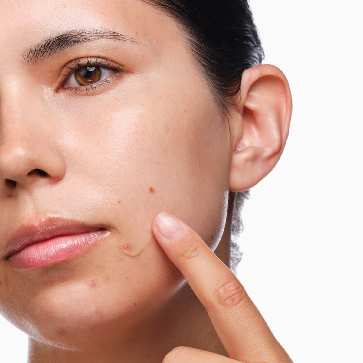 the-acne-set-s3 rdn-the-acne-set-application.png